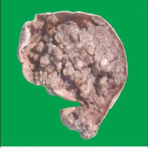 （圖）卵巢漿液性腫瘤