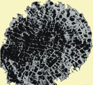 遺傳性球形細胞增多症 遺傳性球形細胞增多症