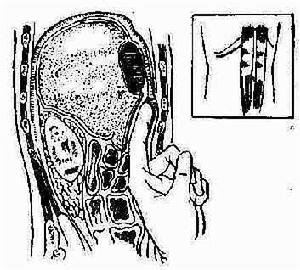 自發性細菌性腹膜炎