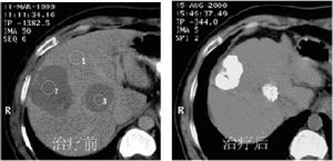絕經期盆腔臟器脫垂