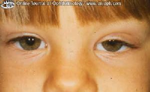 上胞下垂 上胞下垂