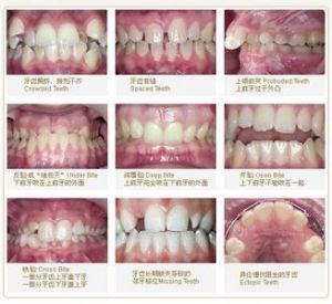 後牙反牙合 後牙反牙合