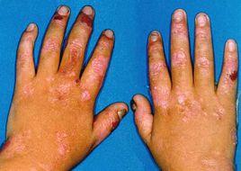 大皰性皮膚病 大皰性皮膚病