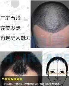 髮際線修復手術