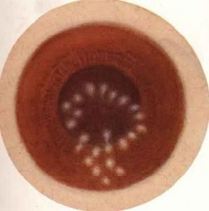 乾燥性角膜結膜炎 乾燥性角膜結膜炎