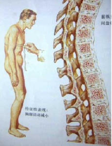強制性脊椎炎