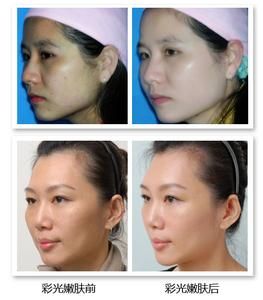 複合彩光美容 複合彩光美容