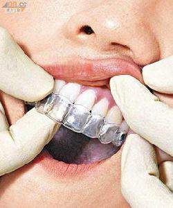 隱形牙箍 隱形牙箍