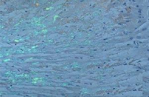 系統性澱粉樣變性