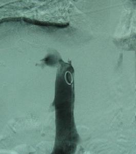 肝靜脈阻塞綜合徵