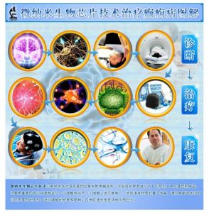 微納米生物晶片技術治療癲癇圖解