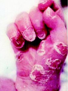 先天性梅毒 先天性梅毒