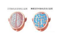 老年人癲癇 老年人癲癇