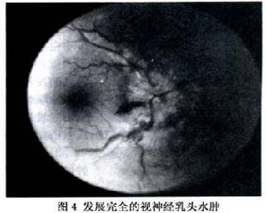 視神經乳頭水腫及視盤水腫