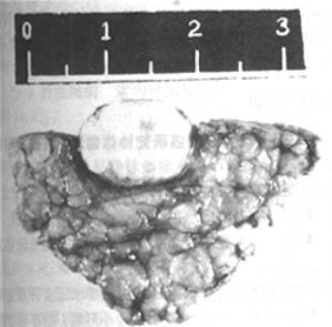 （圖）原發性十二指腸惡性淋巴瘤
