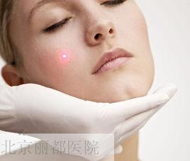 E光祛斑 E光祛斑