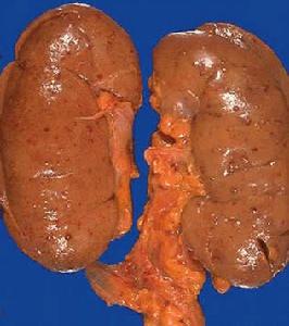 阿米巴肝膿腫