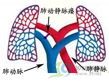 先天性肺動靜脈瘺 先天性肺動靜脈瘺