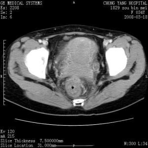 子宮復舊不全 子宮復舊不全