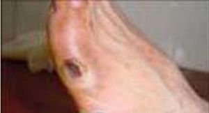 足穿通性損害 足穿通性損害