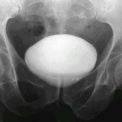 膀胱造影 膀胱造影