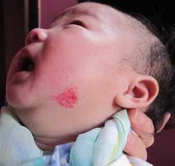 嬰兒海綿狀血管瘤