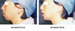 頦部整形美容術