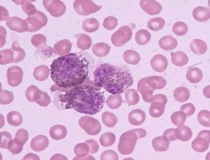 原發性皮膚T細胞淋巴瘤 原發性皮膚T細胞淋巴瘤