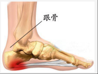 足跟骨刺