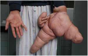 江蘇小伙劉華（化名）在手術前展示巨大的左手和正常的右手