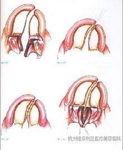 唇裂修復手術 唇裂修復手術