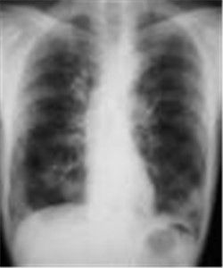 肺泡蛋白沉積症 肺泡蛋白沉積症