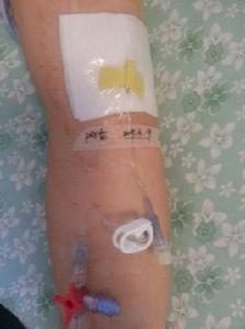 植入式靜脈輸液港 植入式靜脈輸液港