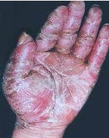 煙酸缺乏症 煙酸缺乏症