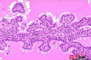 甲狀腺機能亢進