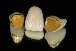 金屬烤瓷聯合冠 金屬烤瓷聯合冠