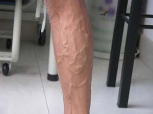 靜脈曲張 靜脈曲張