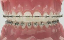 3M陶瓷自鎖托槽