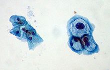 宮頸上皮細胞，左：正常，右：“挖空細胞”