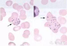 豪焦小體 豪焦小體