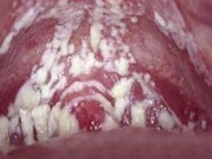 豆渣樣白帶 豆渣樣白帶