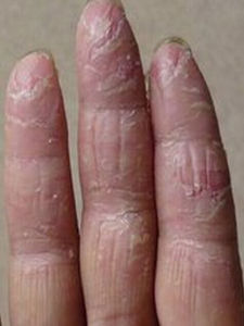 手部濕疹