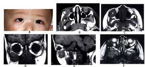 幼年性黃色肉芽腫 幼年性黃色肉芽腫
