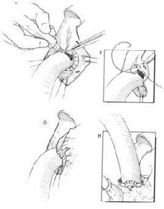 BENTALL手術 BENTALL手術