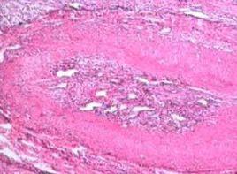 表皮發生鈣化 表皮發生鈣化