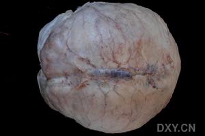 硬腦膜外血腫 硬腦膜外血腫