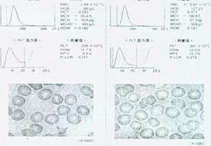 營養性缺鐵性貧血