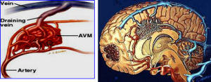 腦動靜脈畸形