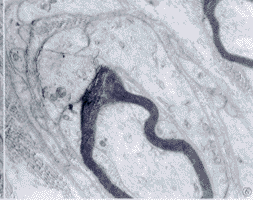 格林巴利綜合症