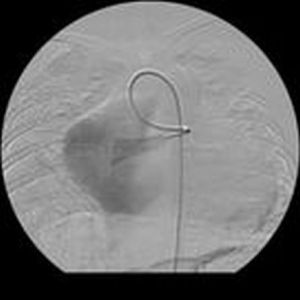 導管置入減影圖
